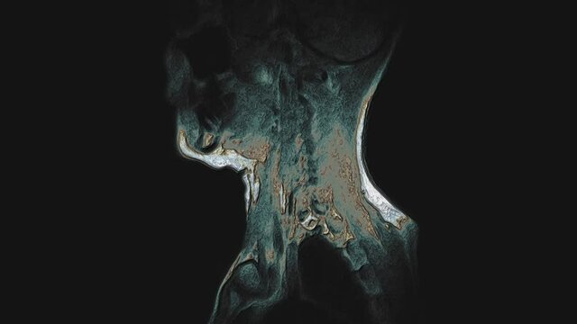 Bulk multicolored MRI of the cervical spine, detection of protrusions and hernias
