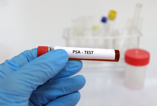 A hand with a blue nitrile glove, holds between its fingers a vial of blood in a test to analyze the psa, specific prostate antigen
