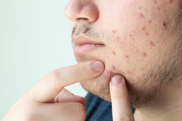 young man squeezing a pimple, men's skincare concept