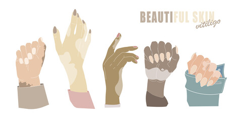 Hands with age spots or vitiligo isolated vector. Hand gestures with genetic skin disease. Woman's hands with manicure