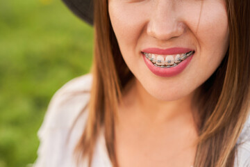 Smile not ashamed of braces, smile of a girl close-up, self-ligating braces