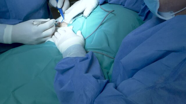 Surgeon doctor performing a small surgery and removing fibroma from a patient