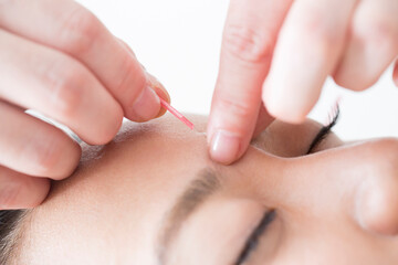 鍼治療イメージ