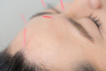 鍼治療イメージ