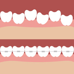 The teeth in braces in the gums in the mouth are healthy