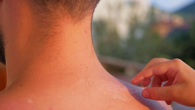 children's hand lifts the sunburn skin.