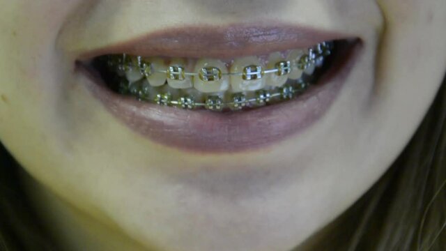 Video of smiling young girl with dental braces showing tongue. Closeup shot of lips and teeth in metal orthodontic braces. Dentistry health care treatment. High quality FullHD footage.