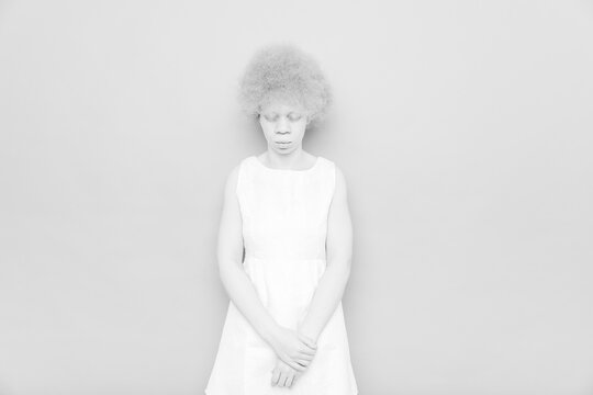 Portrait of albino young woman