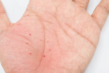Atopic dermatitis (AD) on the hand, also known as atopic eczema or dyshidrotic eczema. Allergy on skin.