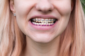Beautiful young girl with metal dental braces with white teeth