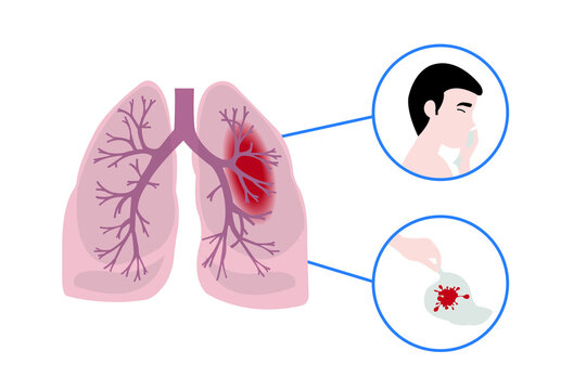 lung bleeding, hemoptysis