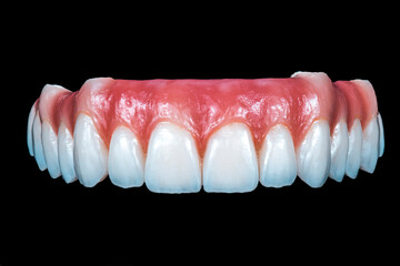 full ceramic tooth on 6 implants ( all on 6 )