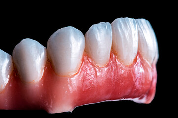 full ceramic tooth on 6 implants ( all on 6 )