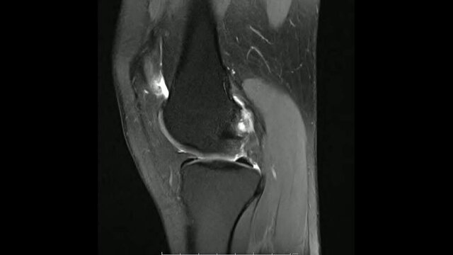 Magnetic Resonance images of  The Knee joint Sagittal Proton density Images in cine mode (MRI Knee joint) showing the anatomy of the knee