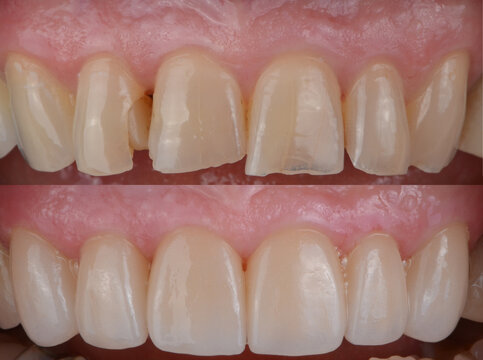 The natural-looking smile makeover with the dental ceramic veneer and crown
