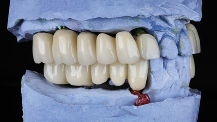 ceramic bridges dentures on almost the entire jaw, on plaster models