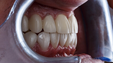 Obraz premium prosthetics of the patient's upper and lower jaw with veneers and crowns, dental photo with mouth dilators