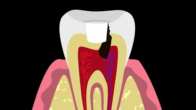 Сaries under the tooth filling HD, alpha channal	