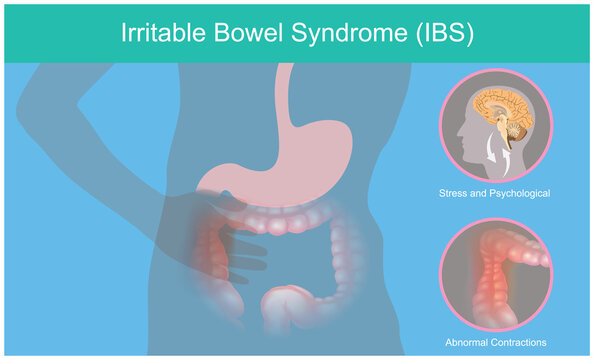 Irritable Bowel Syndrome. Illustration explain abnormal contractions and pain perception human bowel as a result of the brain stress responses. .