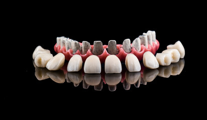 all on six dental ceramic restoration on implants