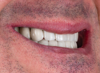 Obraz premium all on six dental ceramic restoration on implants