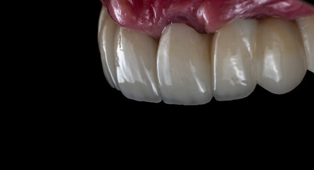 Fototapeta na wymiar all on six dental ceramic restoration on implants