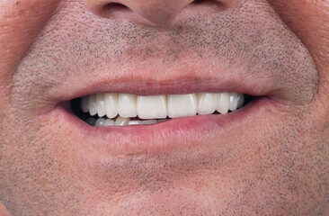all on six dental ceramic restoration on implants