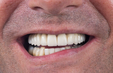 all on six dental ceramic restoration on implants