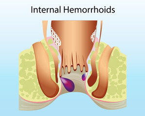 Internal hemorrhoid. Unhealthy lower rectum with inflamed vascular structures, illustration