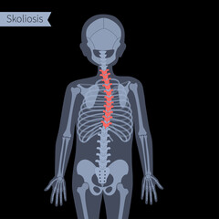 Spine X ray