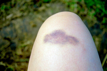 Closeup Bruise on wounded woman s leg skin. Domestic violence, abuser. Close up macro.