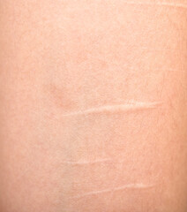 Fototapeta premium Scars on skin