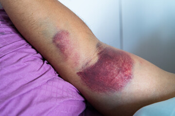 Bicep tear or strain, tendon injuries on a muscular man hand. Trauman or trauma injury. Health and...