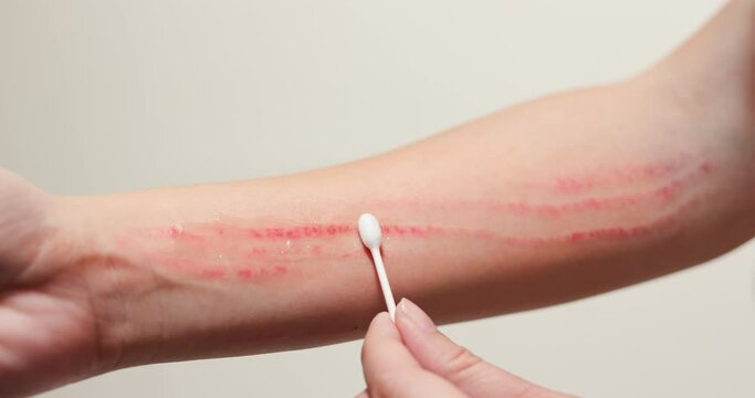Apply ointment on forearm