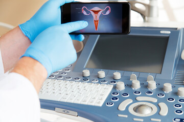 Ręka lekarza w niebieskiej rękawiczce pokazuje na monitorze telefonu ilustrację szyjki macicy. 