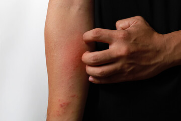 Close up dermatitis on the skin, ill allergic rash dermatitis eczema skin of a patient, atopic dermatitis symptom skin detail texture. Fungus of human skin. - obrazy, fototapety, plakaty