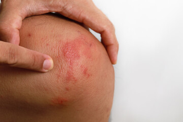 Close up dermatitis on skin, ill allergic rash dermatitis eczema skin of patient , atopic...