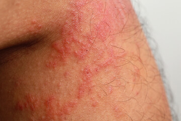 Close up dermatitis on skin, ill allergic rash dermatitis eczema skin of patient , atopic dermatitis symptom skin detail texture , Fungus of skin ,The concept dermatology.