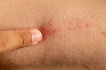 Fototapeta premium Close up dermatitis on skin, ill allergic rash dermatitis eczema skin of patient , atopic dermatitis symptom skin detail texture , Fungus of skin ,The concept dermatology.