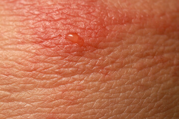 Fototapeta premium Close up dermatitis on skin, ill allergic rash dermatitis eczema skin of patient , atopic dermatitis symptom skin detail texture , Fungus of skin ,The concept dermatology.