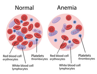 Vector illustration of anemia