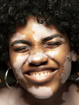 Portrait Of African-american Woman With Vitiligo Skin. Special Skin With Depigmentation Because Of Melanin Losing. Concept Of Skincare And Healthcare, Inclusion And Diversity, Fashion And Beauty.