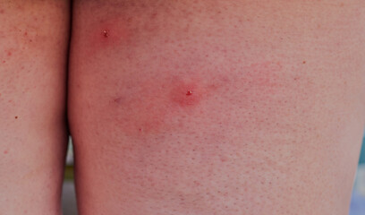 Insect bites on back of legs.