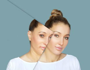 Effects of ageing,Frown/scowl lines ,Nasolabial folds,Neck ,Under eye circles,neck lines.	Plastic...