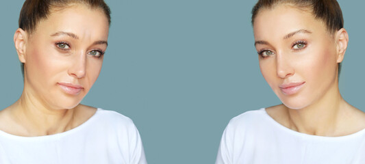 Effects of ageing,Frown/scowl lines ,Nasolabial folds,Neck ,Under eye circles,neck lines.	Plastic Surgery Results