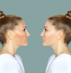 Dark spots, freckles,hyperpigmentation(melasma or chloasma)	