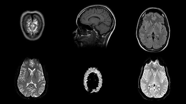Time lapse of MRI brain scan set, timelapse magnetic resonance imaging of a human head. Stop motion view of CT scan with anatomical details. Seamless loop animation of the human head.