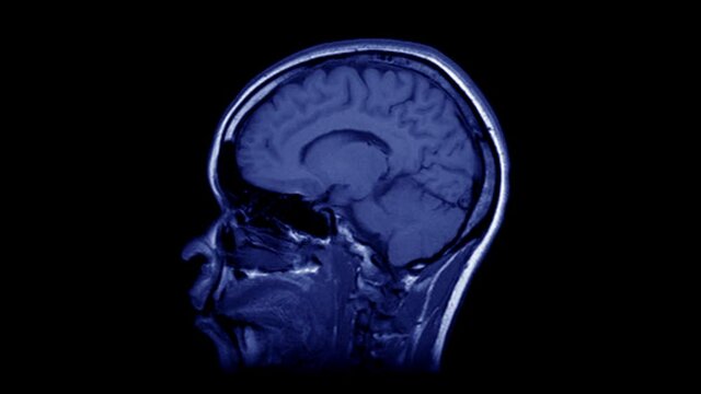 Time lapse of MRI brain scan, timelapse of blue magnetic resonance imaging of a human head. Stop motion view of CT scan with anatomical details. Seamless loop animation of the human head.