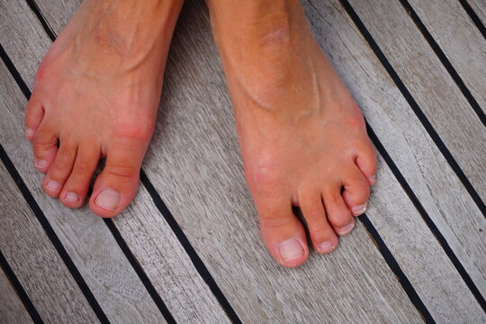 Woman's Foot. Hammer Toes On The Deck Of A Sailing Boat.