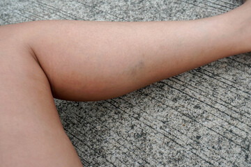 close up woman left leg with bruise wound